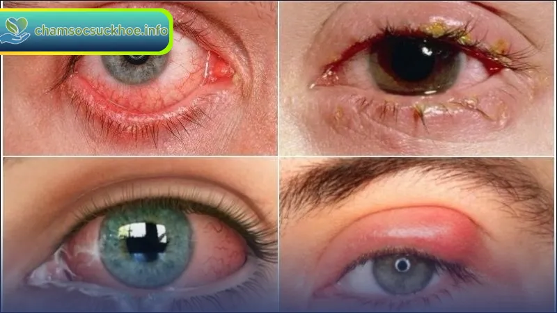 Đau Mắt Đỏ Lây Qua Đường Nào Và Cách Phòng Tránh Hiệu Quả
