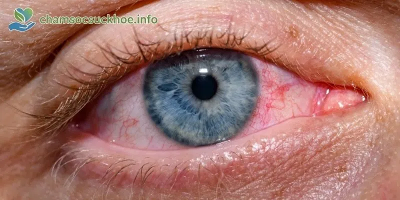 Con đường lây lan chính của bệnh đau mắt đỏ