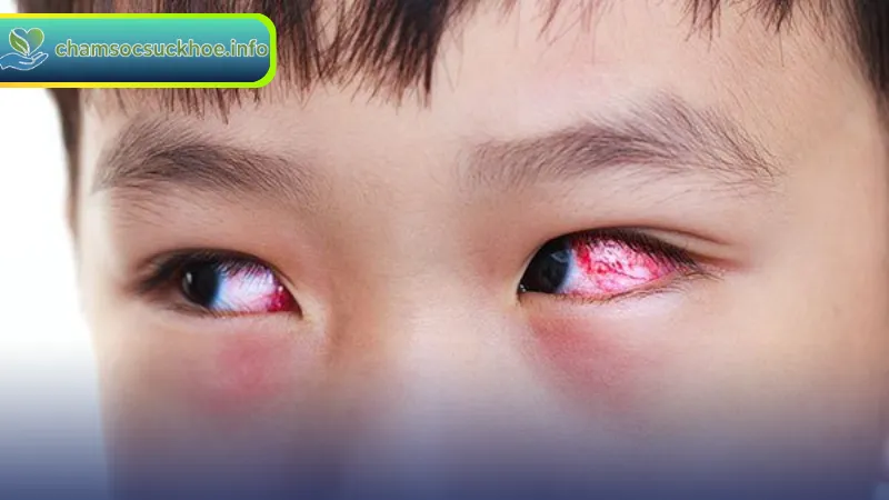 Những đối tượng dễ mắc bệnh đau mắt đỏ
