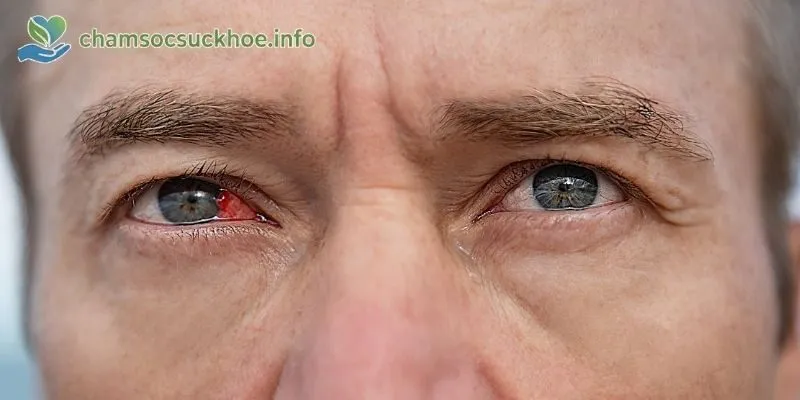 Đau Mắt Đỏ Lây Qua Đường Nào
