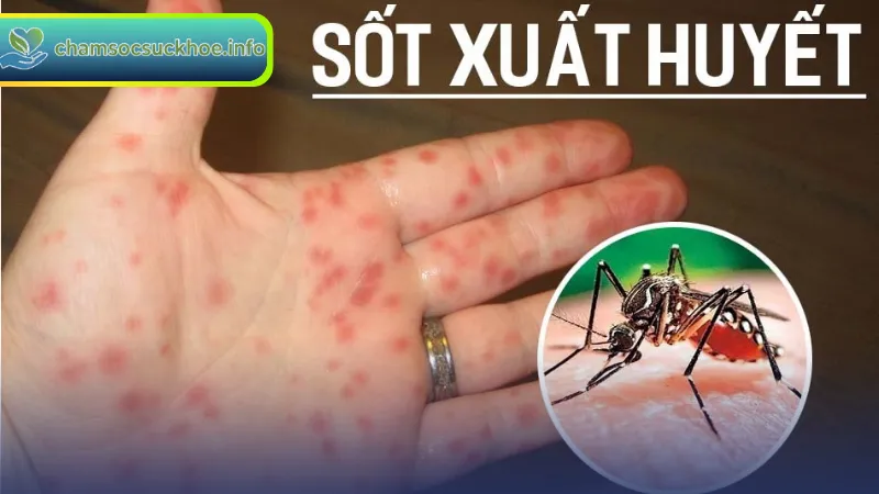 Nguyên nhân và cơ chế lây lan của sốt xuất huyết