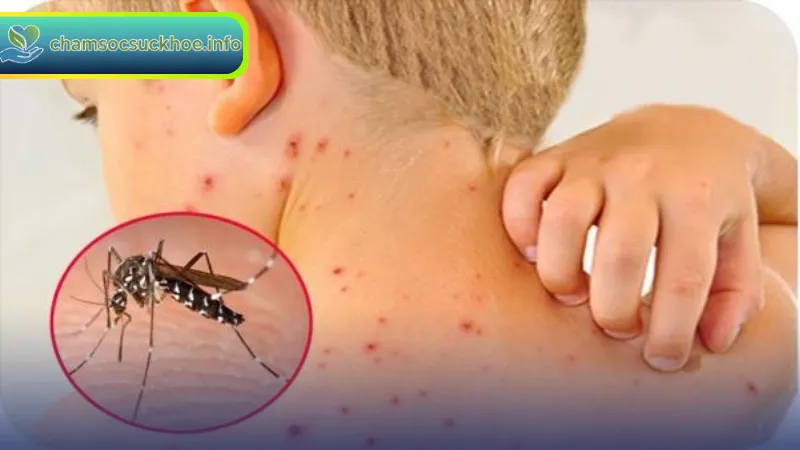 Triệu chứng và biến chứng nguy hiểm của sốt xuất huyết
