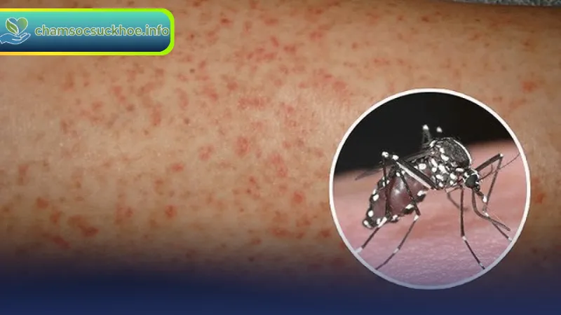 Cách chăm sóc và điều trị sốt xuất huyết tại nhà