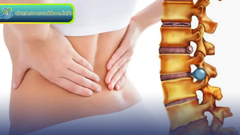 Thoát Vị Đĩa Đệm Là Gì? Nguyên Nhân Và Cách Điều Trị