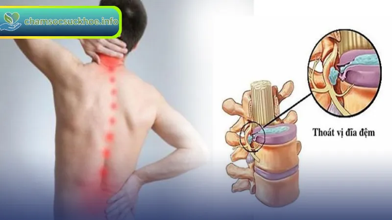 Nguyên nhân gây thoát vị đĩa đệm và các yếu tố nguy cơ thường gặp