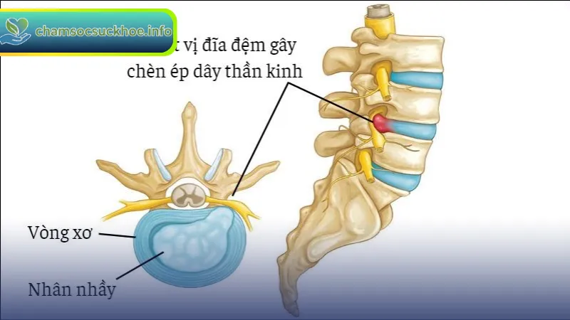 Triệu chứng và biến chứng của thoát vị đĩa đệm