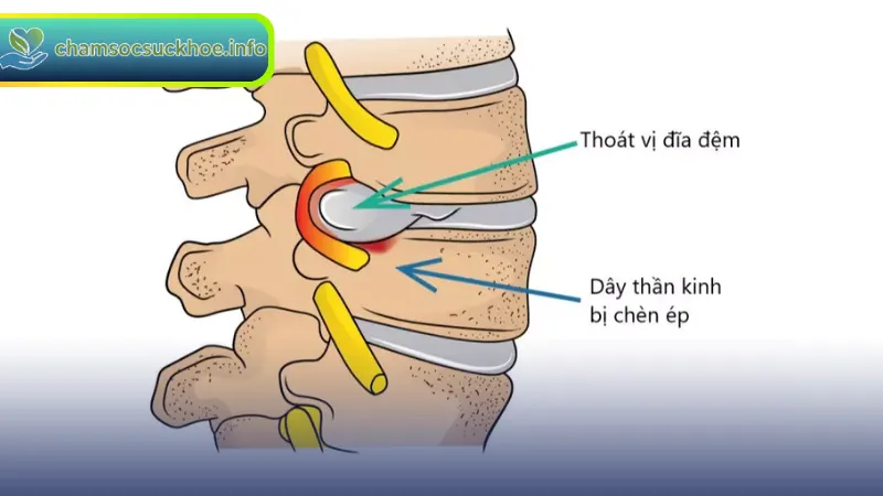 Phương pháp chẩn đoán và điều trị thoát vị đĩa đệm