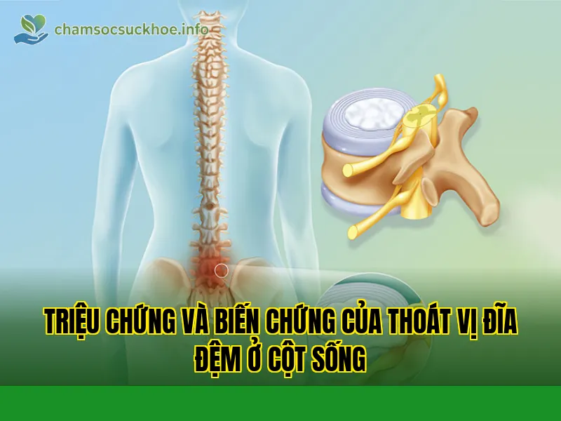 Triệu chứng và biến chứng của thoát vị đĩa đệm ở cột sống
