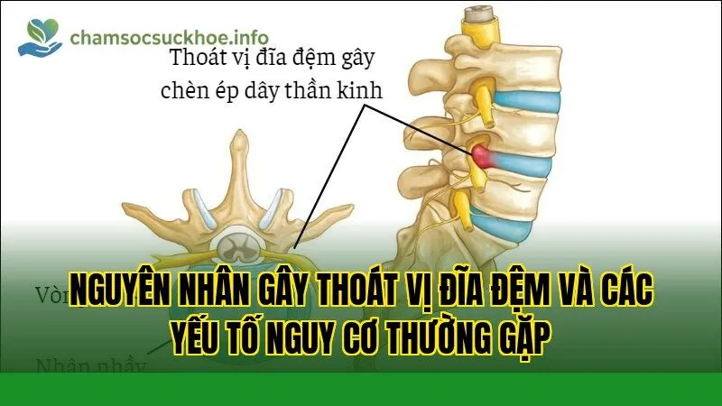 Nguyên nhân gây thoát vị đĩa đệm và các yếu tố nguy cơ thường gặp