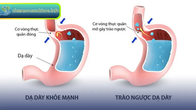 Trào Ngược Dạ Dày: Nguyên Nhân, Triệu Chứng Và Cách Điều Trị