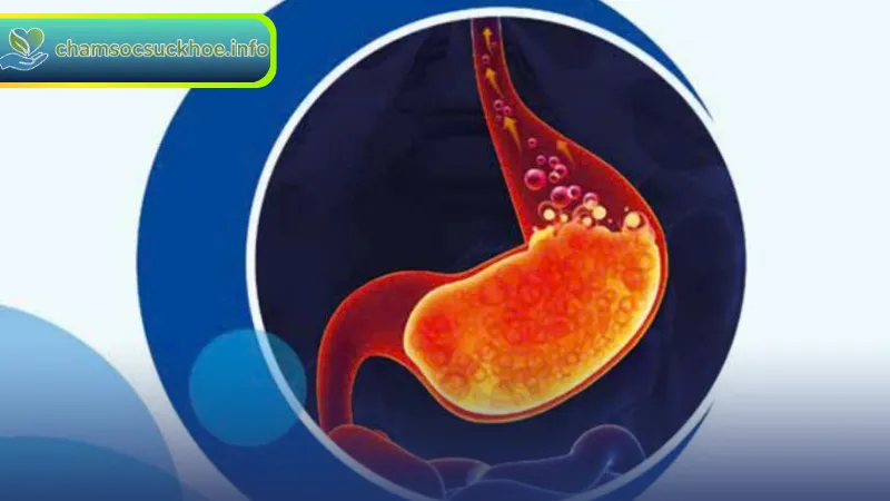 Cách phòng ngừa và điều trị trào ngược dạ dày hiệu quả
