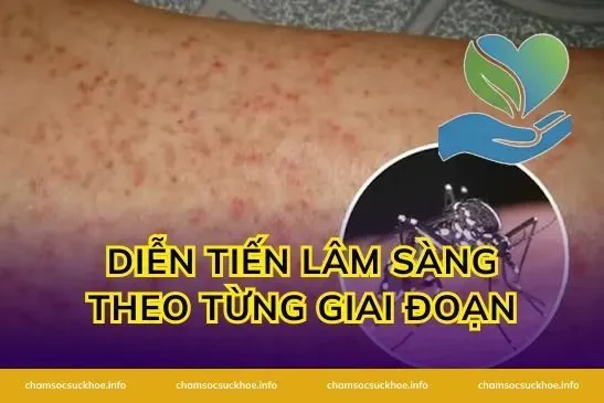 Diễn tiến lâm sàng theo từng giai đoạn