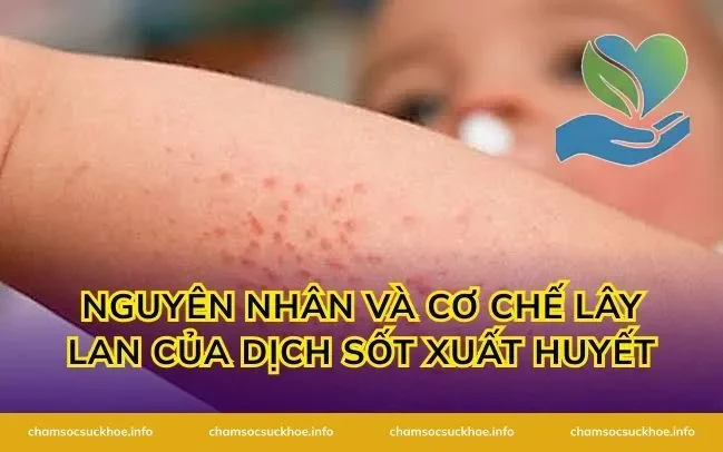Nguyên nhân và cơ chế lây lan của dịch sốt xuất huyết