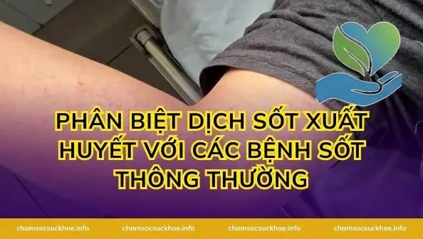 Phân biệt dịch sốt xuất huyết với các bệnh sốt thông thường